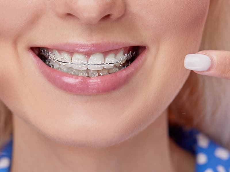 The Benefits of Using Self-Ligating Braces for Shorter Treatment Times